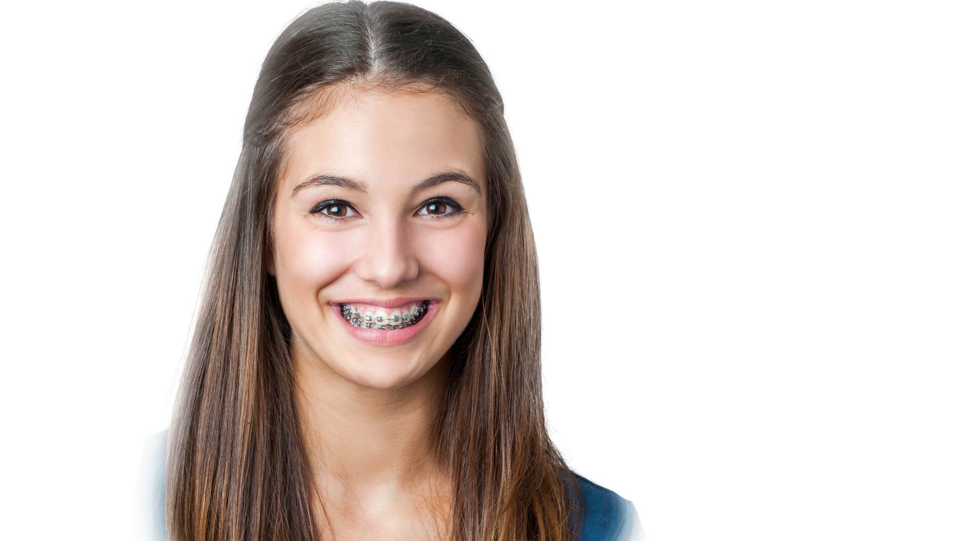 Traditional Braces in Houston
