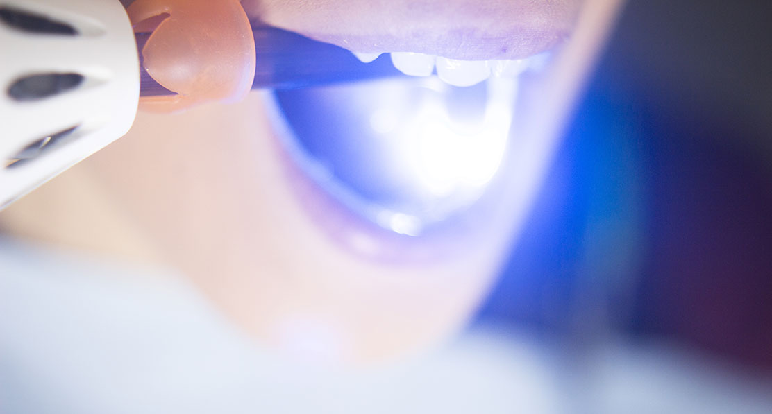 teeth whitening service near you at Houston, TX