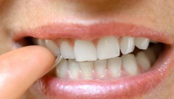 Dental habits you should break